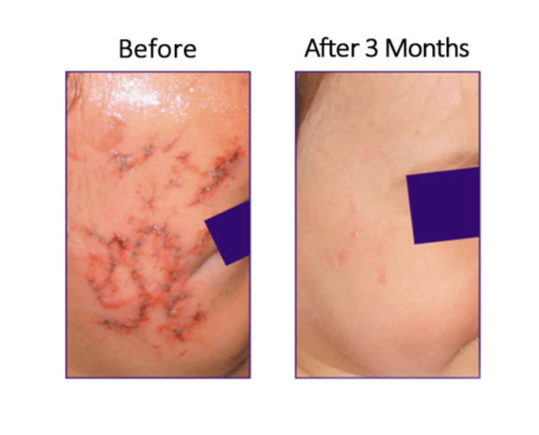 Biocorneum advanced scar treatment sale
