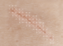 Load image into Gallery viewer, DrFreund Skincare scar treatments Biocorneum® Advanced Scar Treatment with Silishield Patented Crosslinking Silicone with SPF30 Sunscreen Biocorneum Advanced Scar Treatment with SPF 30 Sunscreen
