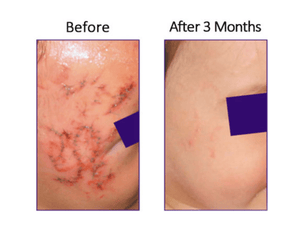 DrFreund Skincare scar treatments Biocorneum® Advanced Scar Treatment with Silishield Patented Crosslinking Silicone with SPF30 Sunscreen Biocorneum Advanced Scar Treatment with SPF 30 Sunscreen